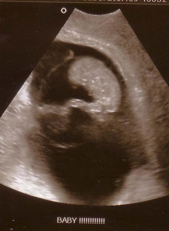 10 week ultrasound